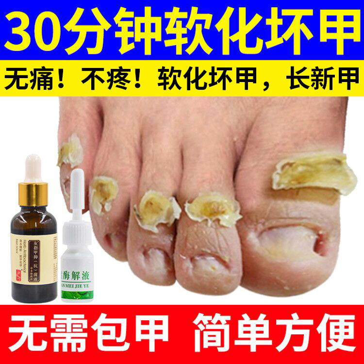 灰指甲专用脱甲膏贴抑菌液药治疗去脚趾亮甲正品灰甲净日本冰醋酸