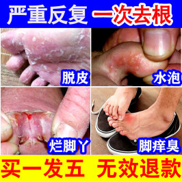 脚气喷剂去根止痒脱皮水泡真菌感染烂脚丫杀菌药膏脚臭脚汗神器