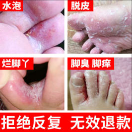 脚氣止痒脱皮殺菌水泡去烂脚丫根的药膏除香港脚神器脚痒型
